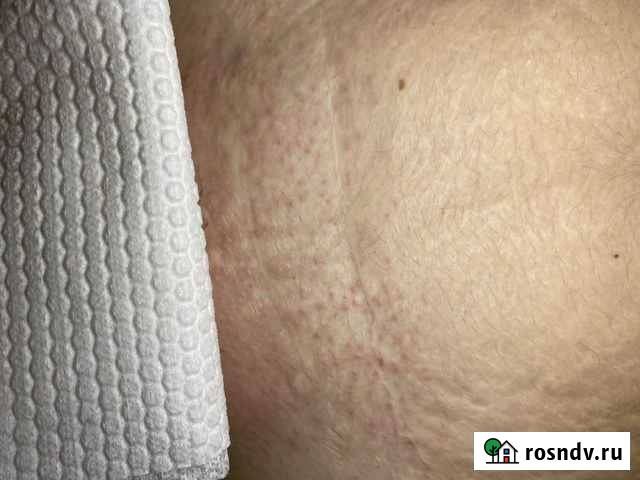 Электроэпиляция Астрахань - изображение 1