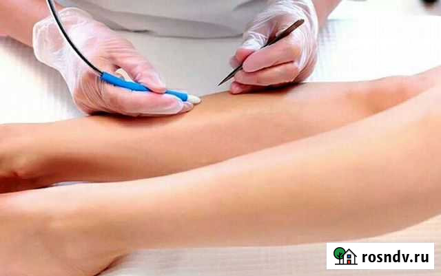 Электроэпиляция Махачкала - изображение 1