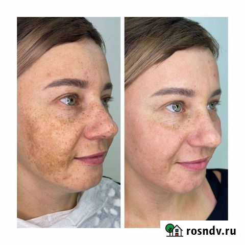 Лазерная шлифовка Новосибирск - изображение 1