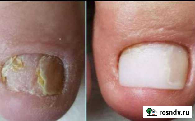 Педикюр медицинский Анапа - изображение 1