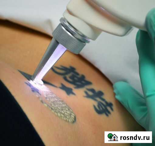 Удаление татуажа и татуировок лазером Бузулук - изображение 1