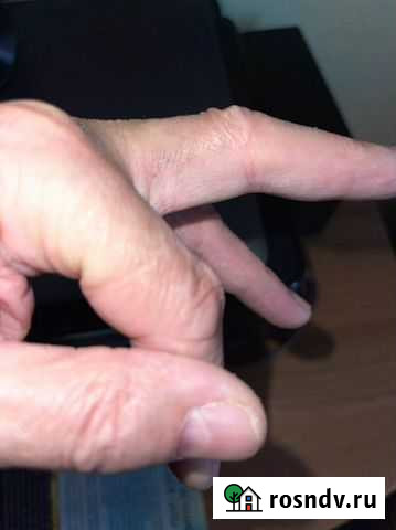 Лазерное удаление бородавок, попилом, эпиляция Москва - изображение 1