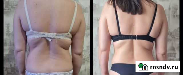 Жиросжигающий массаж Древлянка Петрозаводск - изображение 1