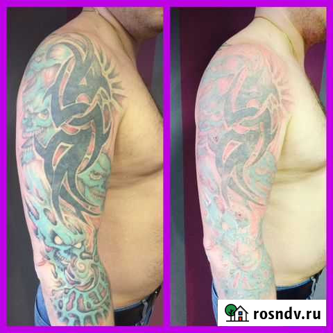 Удаление татуировок и перманентного макияжа Санкт-Петербург - изображение 1