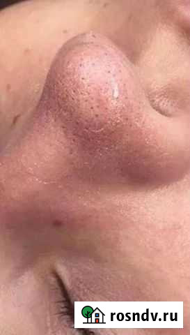 Чистка кожи лица, коррекция фигуры Верхняя Пышма - изображение 1