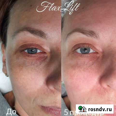 Пилинг, неинвазивная процедура Кемерово - изображение 1