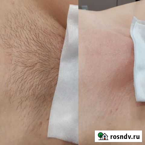 Шугаринг/воск женский и мужской Волгоград - изображение 1