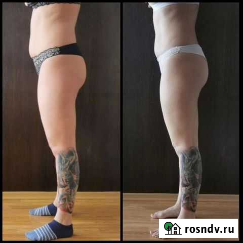 Антицеллюлитный массаж Красноярск - изображение 1