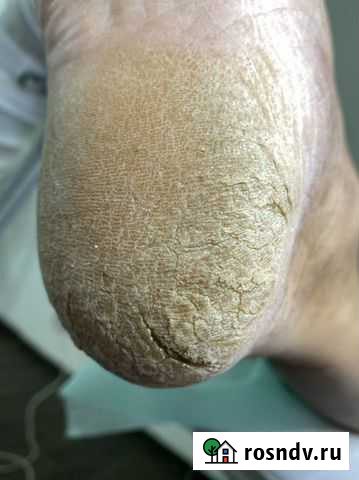 Медицинский педикюр Белогорск - изображение 1