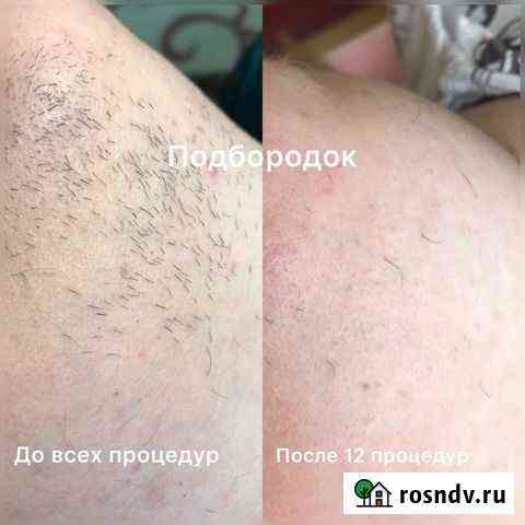 Электроэпиляция в Липецке Липецк