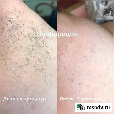 Электроэпиляция в Липецке Липецк - изображение 1