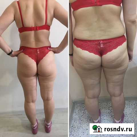 Антицеллюлитный массаж и массаж лица Петрозаводск - изображение 1