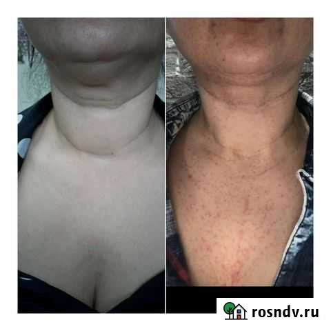 Холодная плазма Владикавказ - изображение 1