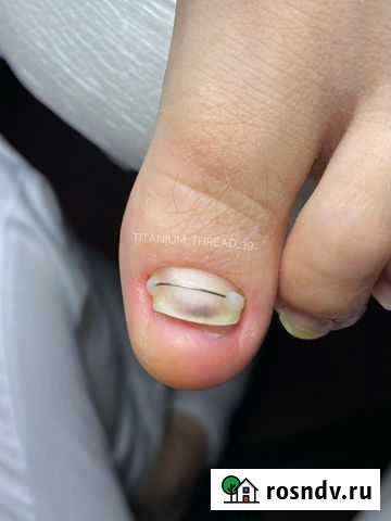 Установка титановой нити Калининград - изображение 1