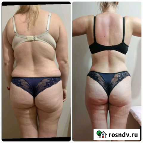 Массаж Аппаратный, Кавитация, RF-Лифтинг Вакуумный Челябинск - изображение 1