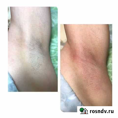 Депиляция Воском Череповец - изображение 1