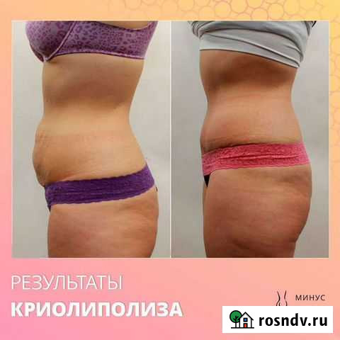 Криолиполиз-избавтесь от жира И целюлита Норильск - изображение 1