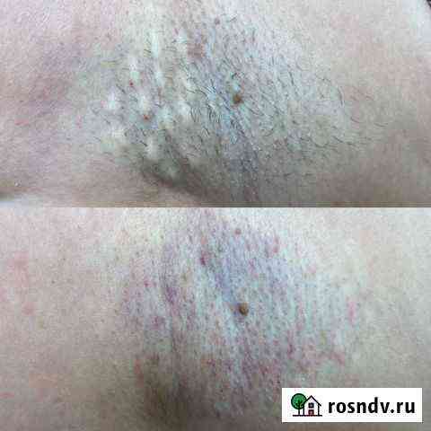 Электроэпиляция Калуга