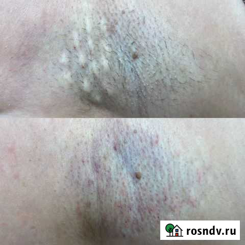 Электроэпиляция Калуга - изображение 1