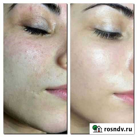 Косметолог: чистка лица, пилинг, массаж лица, уход Москва - изображение 1