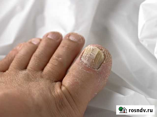 Грибок ногтей бородавки удаление Киров - изображение 1