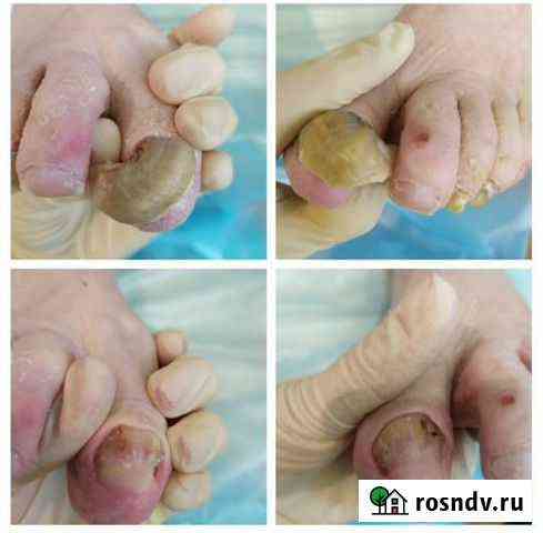 Аппаратный педикюр Вологда