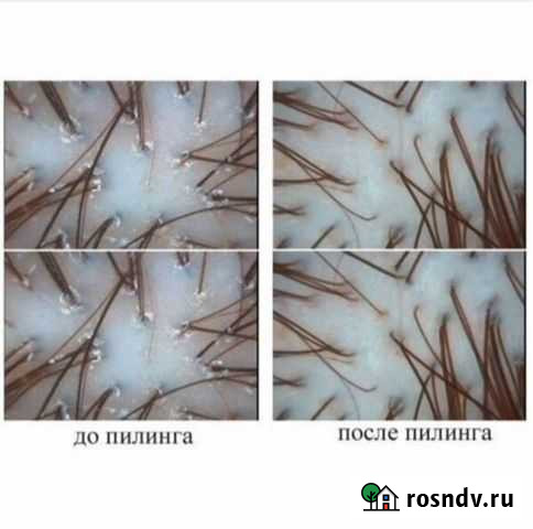 Пилинг для кожи головы Мичуринск - изображение 1