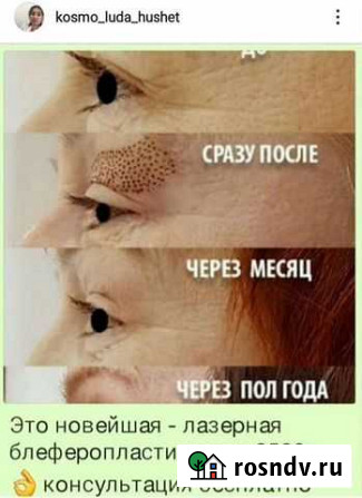 Лазерная блеферопластика Новый Хушет - изображение 1