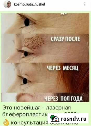 Лазерная блеферопластика Новый Хушет - изображение 1