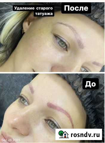 Удаление старого татуажа Вязьма - изображение 1