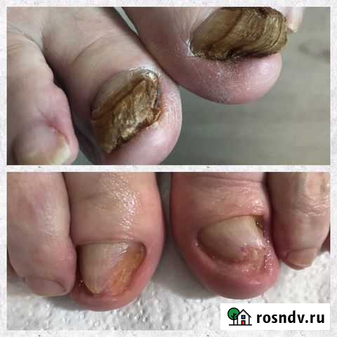 Аппаратный(медицинский) педикюр Иркутск - изображение 1