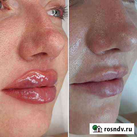 Бьютификация губ Белгород