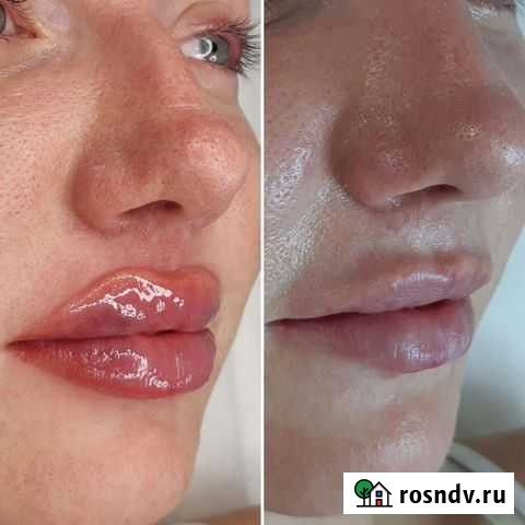 Бьютификация губ Белгород - изображение 1