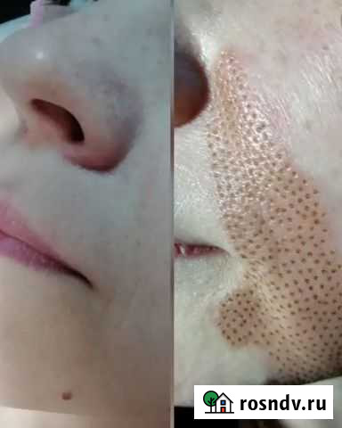 Безоперационная брефалопластика, лифтинг, лечение Оренбург - изображение 1