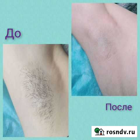 Шугаринг Ярославль - изображение 1