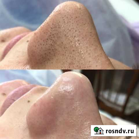 Чистка лица на схи Волгоград - изображение 1