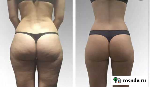 LPG массаж по маслу RF-лифтинг Кавитация Улан-Удэ - изображение 1