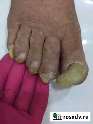 Медицинский педикюр Иркутск - изображение 1