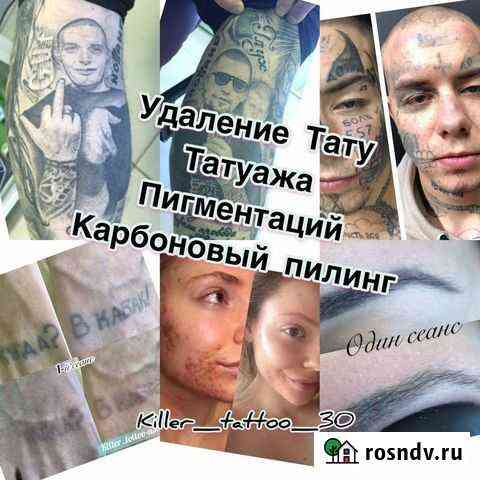 Удаление тату и татуажа Nd-YAG Q-Swich Lazer-ом. К Астрахань