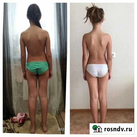 Вальгус сколиоз Набережные Челны - изображение 1