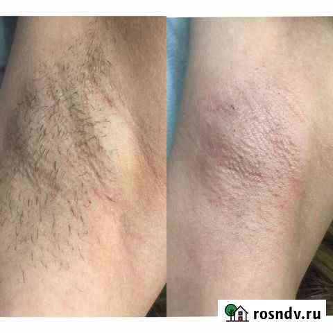 Депиляция Калининград