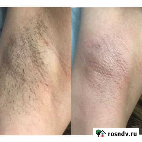 Депиляция Калининград - изображение 1