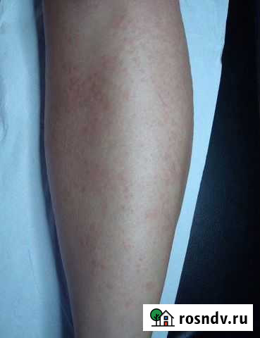 Электроэпиляция свао Москва - изображение 1