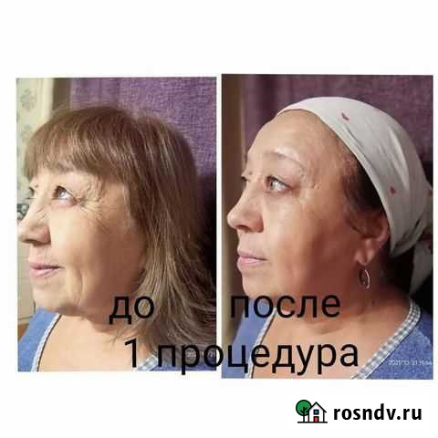 RF лифтинг Магнитогорск - изображение 1