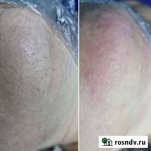 Электроэпиляция Новосибирск - изображение 1