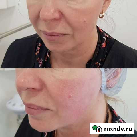 Лифтинг лица Р.ф Балашиха - изображение 1