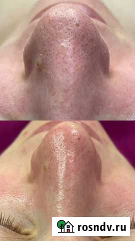 Чистка лица GIGi Москва - изображение 1