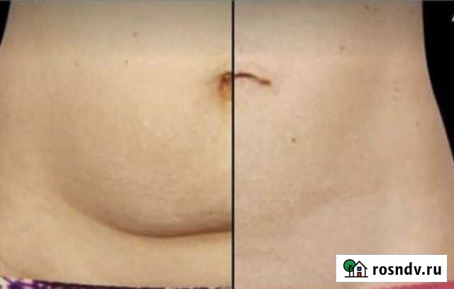 Вакуумная кавитация Москва - изображение 1