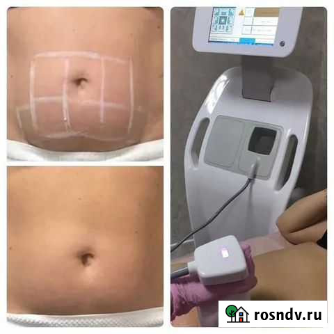 Аренда лазера,Криолиполиза Сергиев Посад - изображение 1