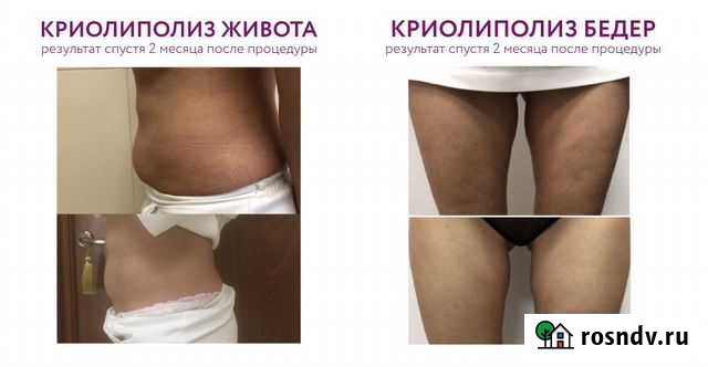 Криолиполиз Владимир - изображение 1